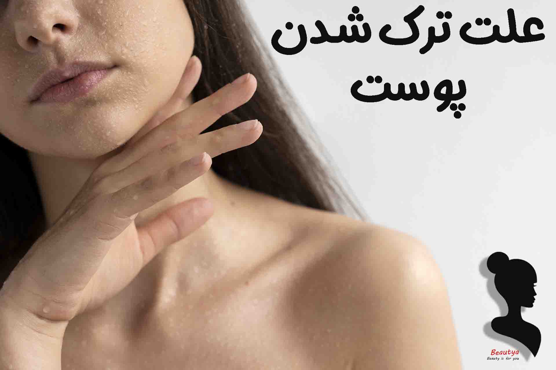 علت ترک خوردن پوست 1