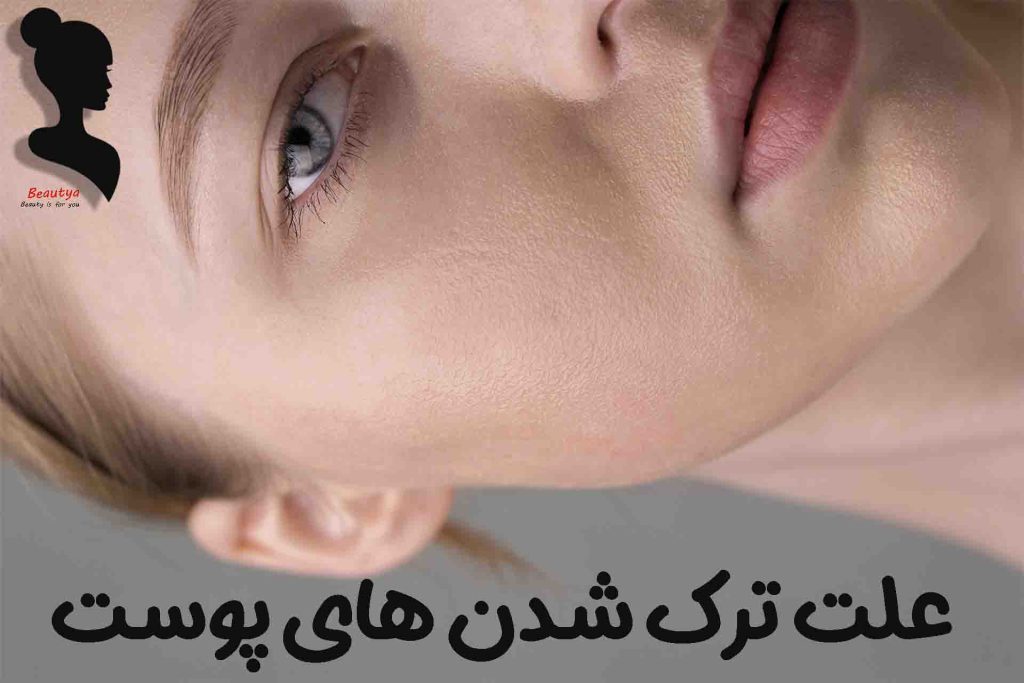علت ترک خوردن پوست