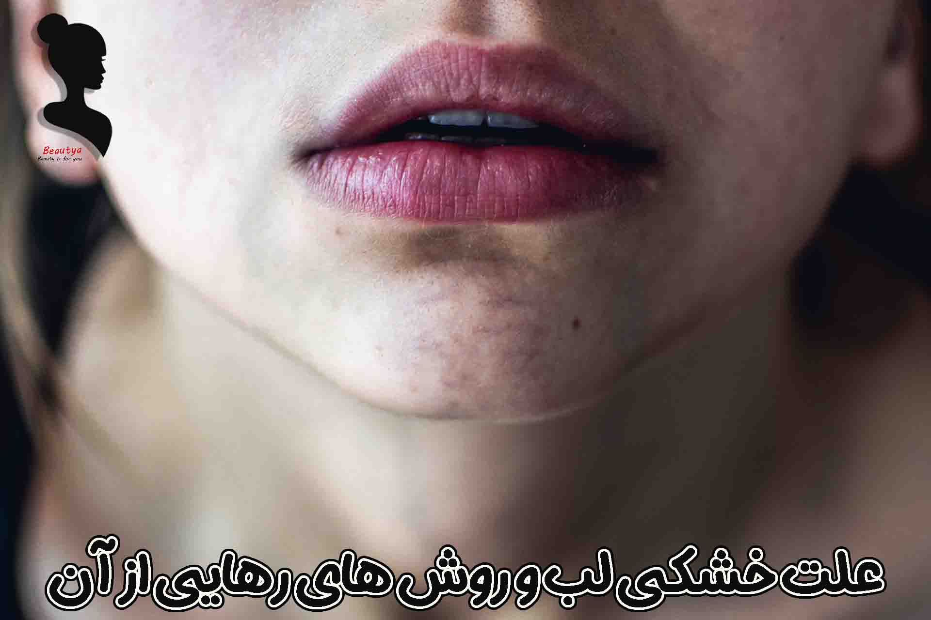 علت خشکی لب