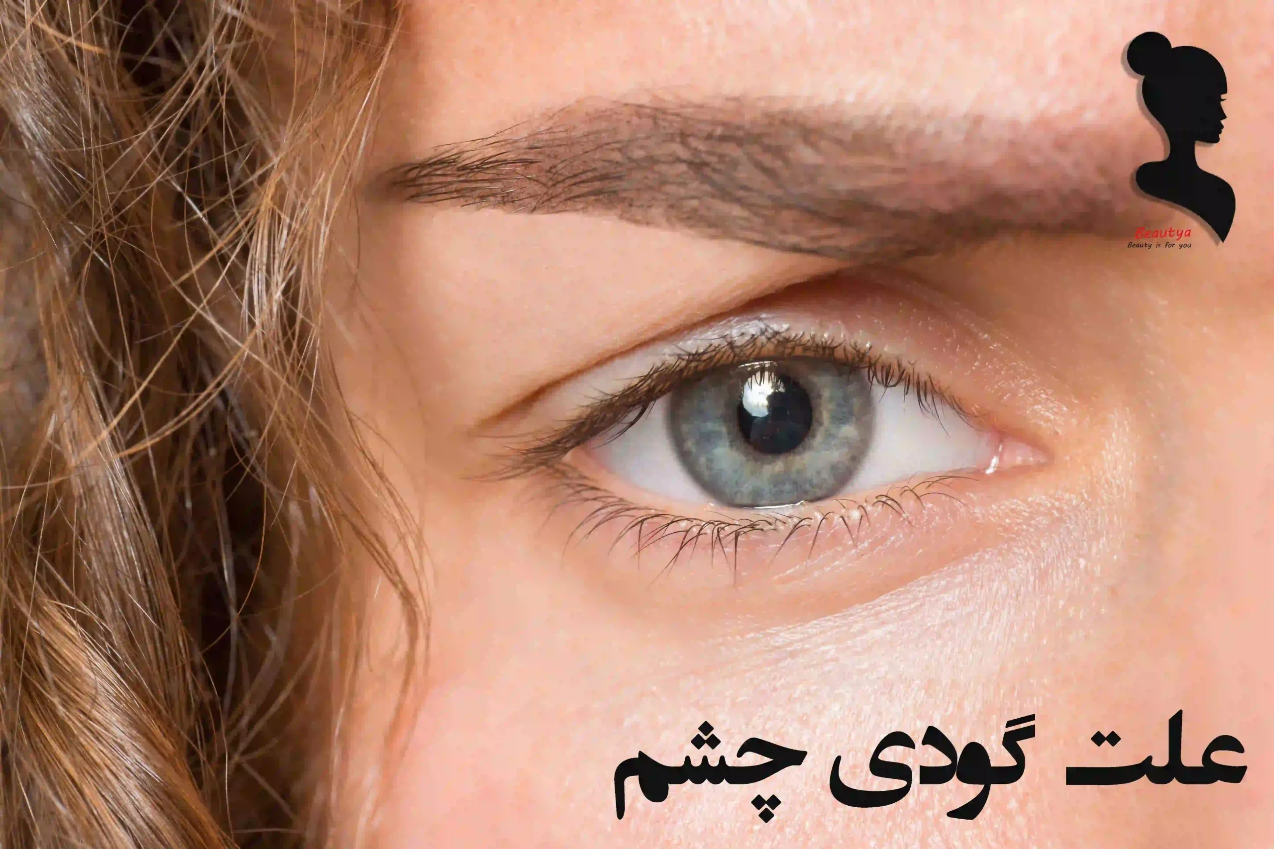 علت گودی چشم 1
