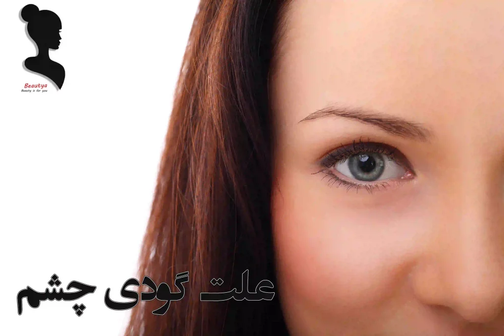 علت گودی چشم