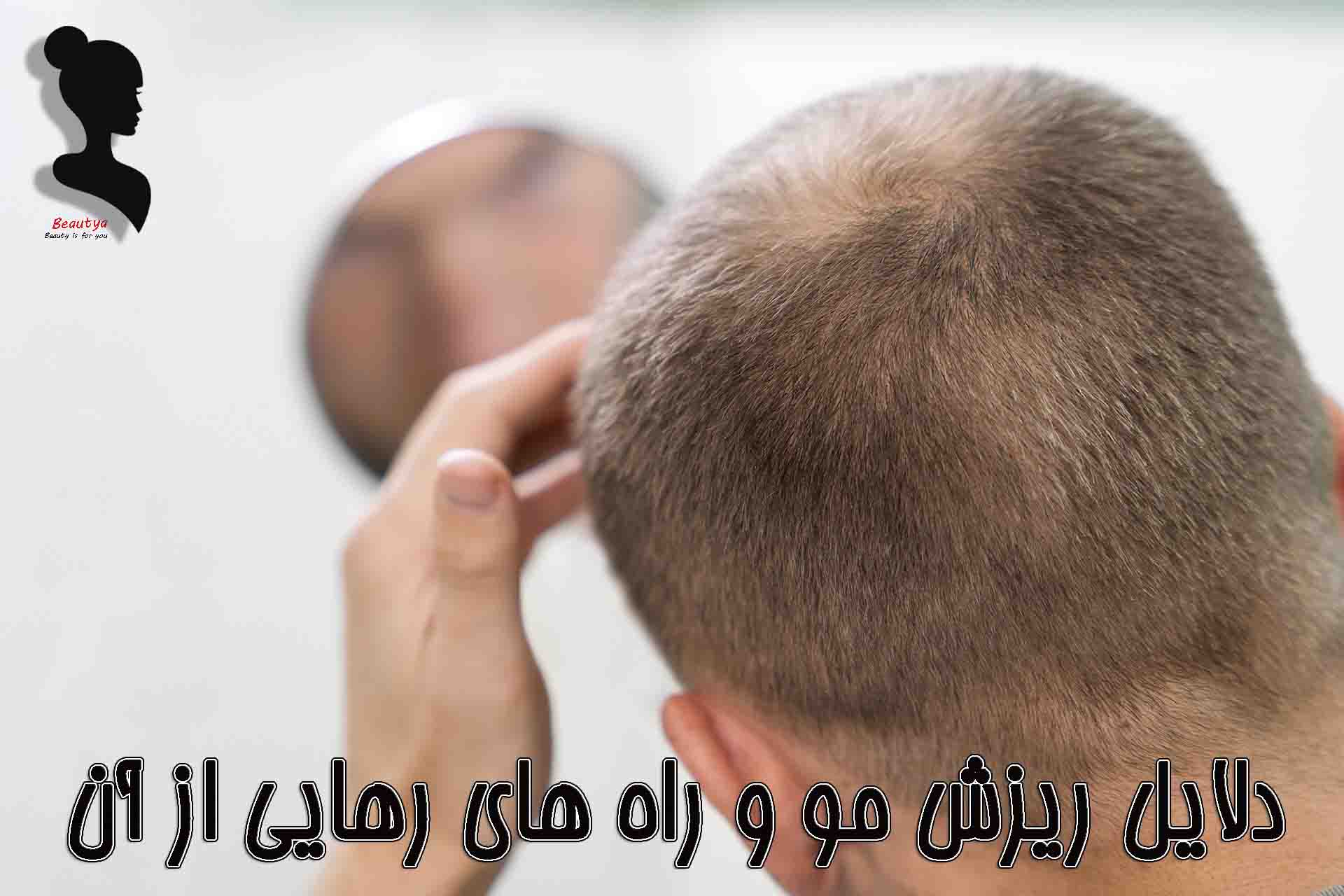 انواع ریزش مو 1