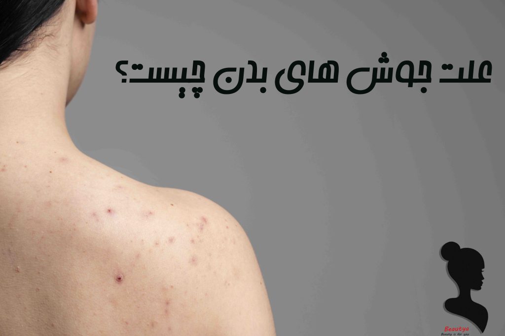 علت جوش های بدن